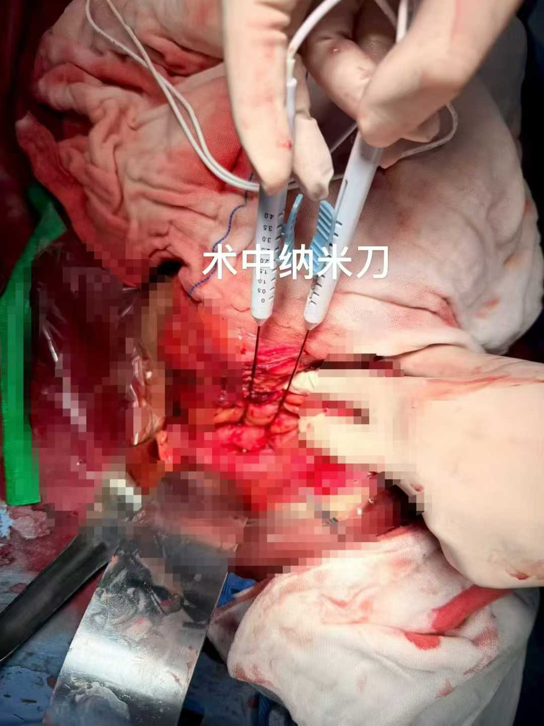 脂肪癌一般寿命多久？