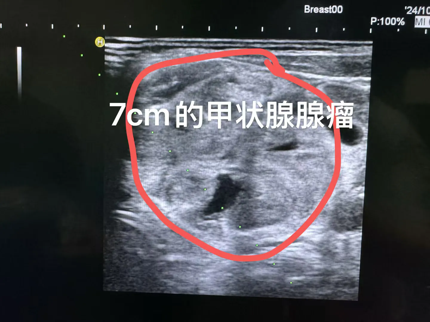 中医能治疗甲状腺癌吗？