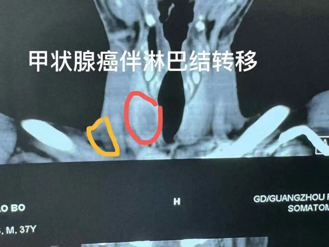 甲状腺癌会死吗？不想留疤不开刀该怎么治疗？