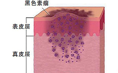 黑色素瘤哪家医院好？