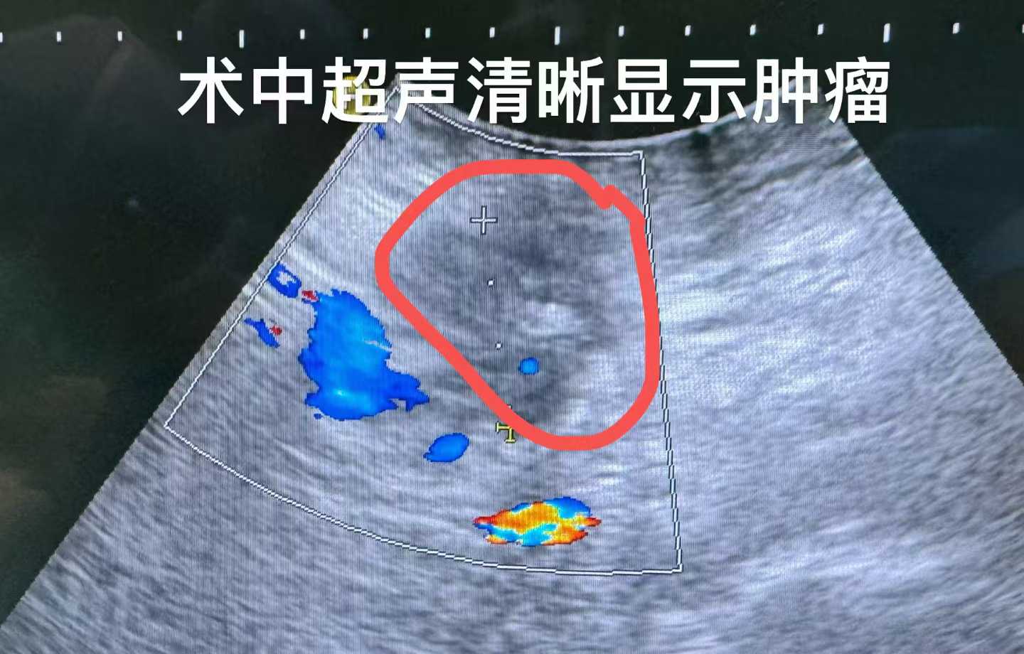 尤文瘤一般长在哪里？可以治愈吗