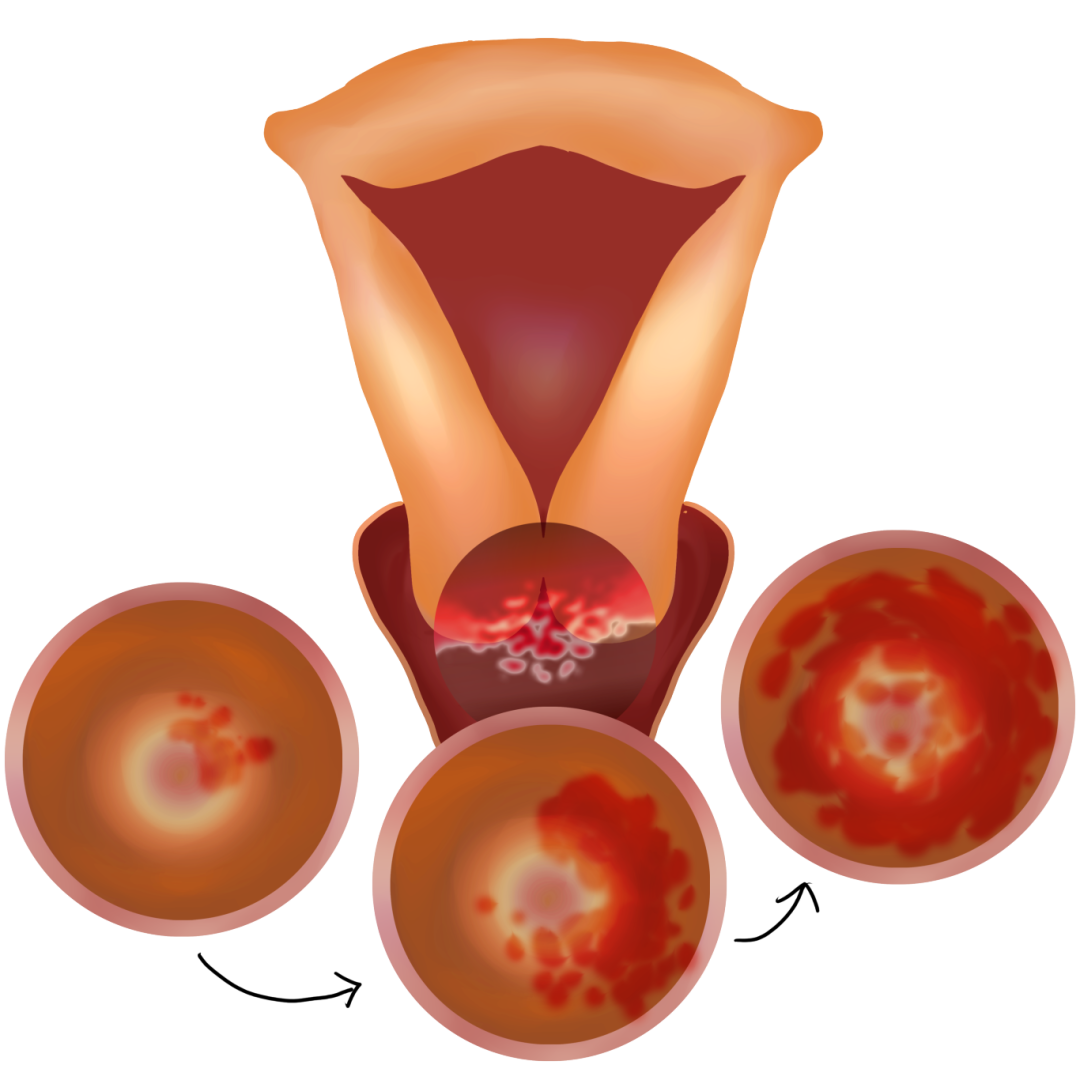 天津宫颈癌症状