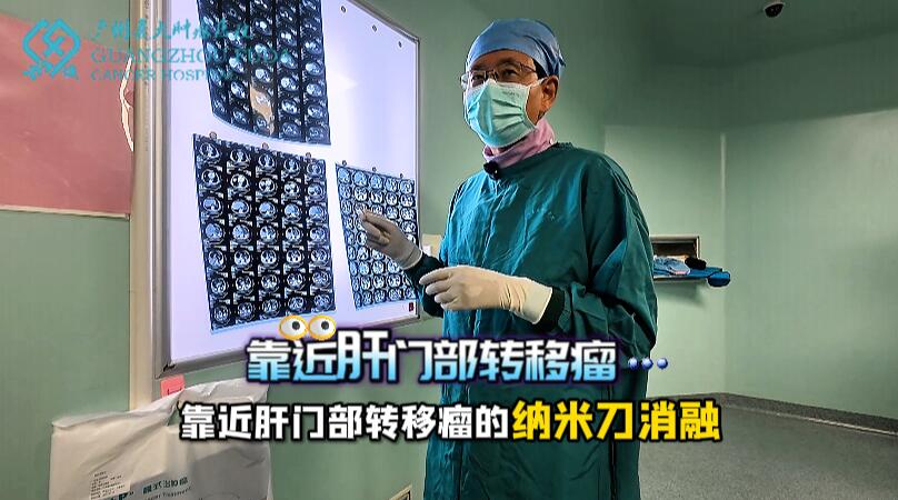 大同國産納米刀消融設備在胰腺癌臨床上的應用