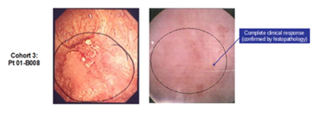 朝阳膀胱癌的发病原因有哪些？