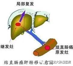 新界肠癌是拖出来的，医生忠告，排便若出现这几种情况有可能是肠癌了