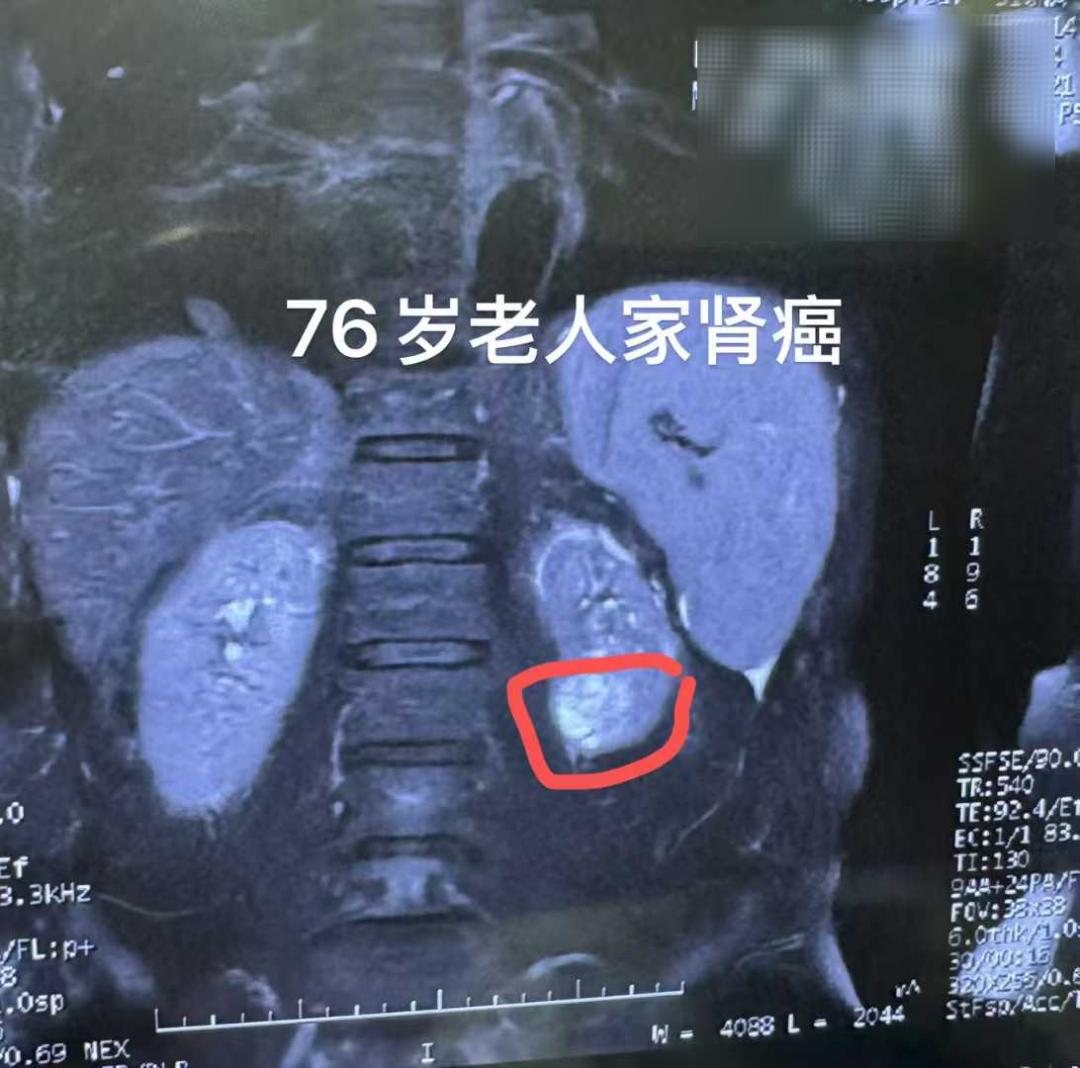 76岁老人家石家庄肾癌