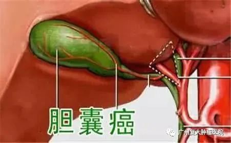 胆囊癌的症状有哪些呢？