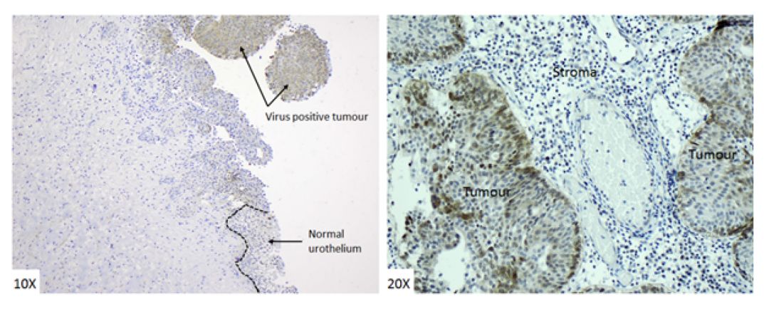 得了膀胱癌，还能活多久？如何判断膀胱癌?