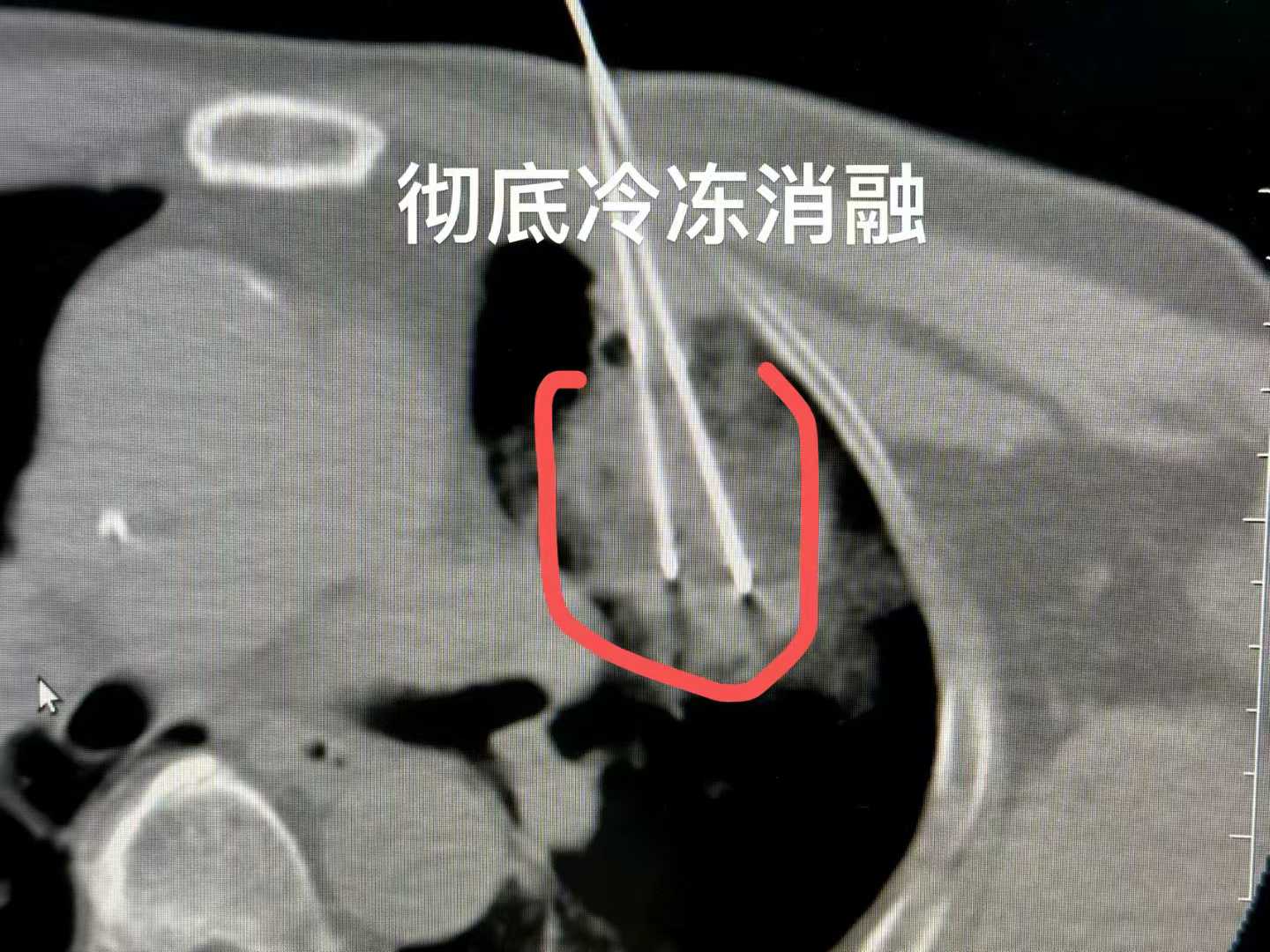 肺癌靶向治疗有效果吗,效果怎样?