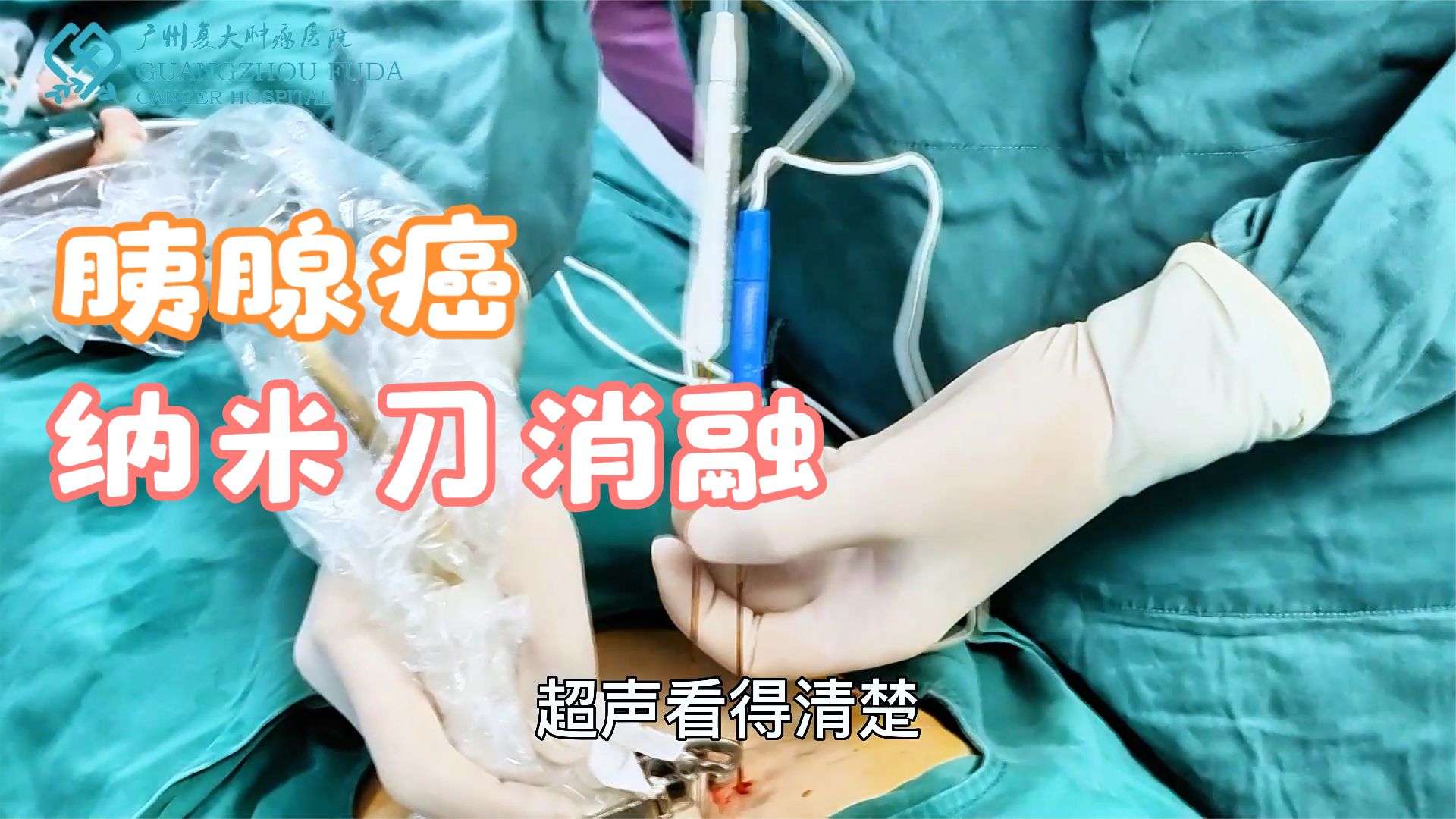 三个步骤看完纳米刀消融胰腺癌微创手术治疗全过程