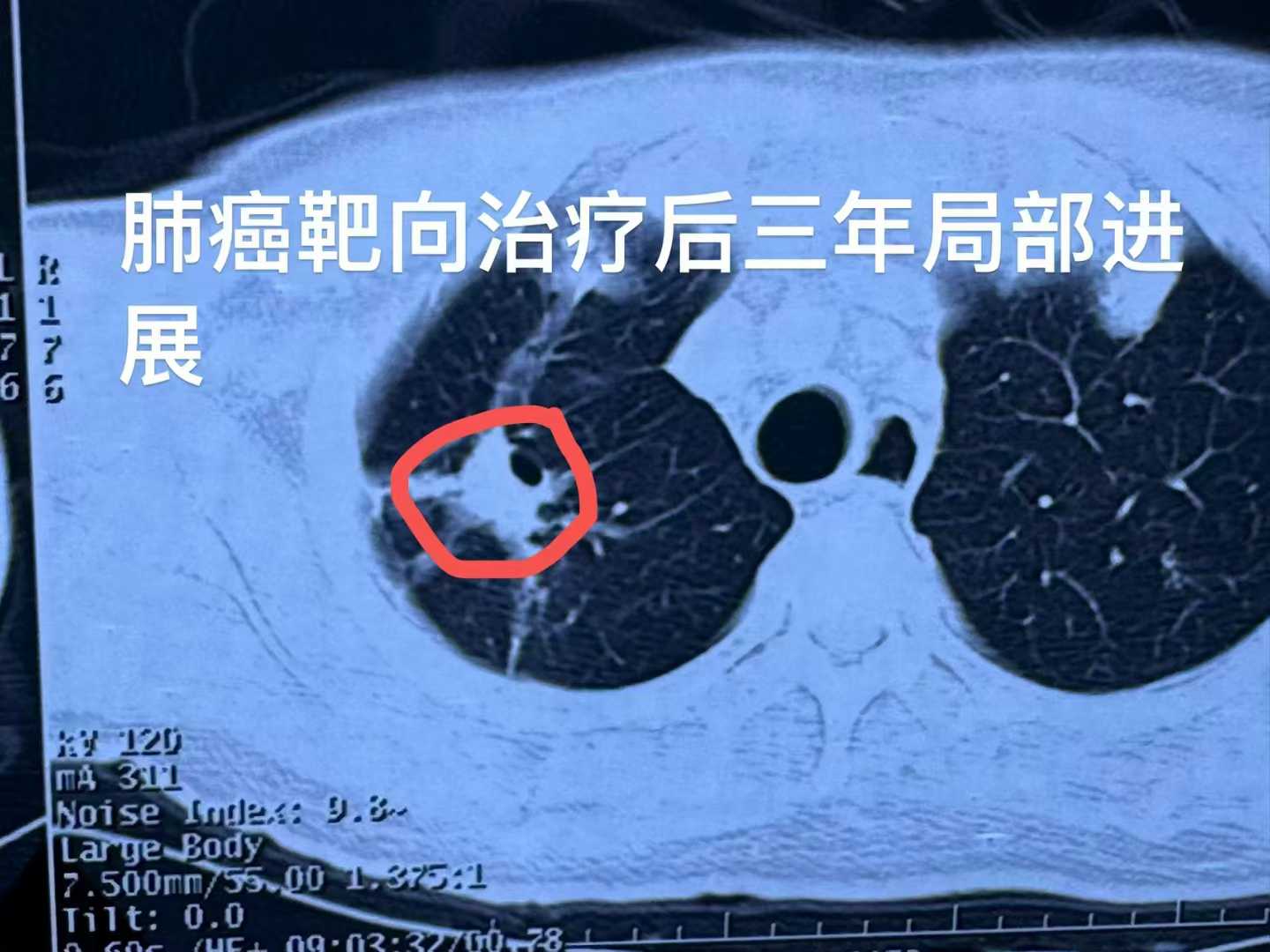 肺癌患者应该如何护理才能降低复发？