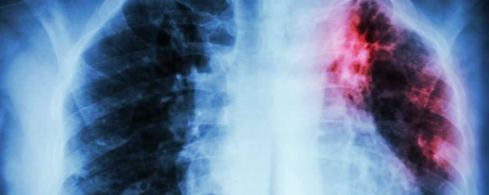 什么是肺癌 治疗肺癌的方法有哪些